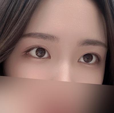 눈밑 꺼짐 처짐 시술 1개월차, 연휴에 받고 만족해요 — 아바성형외과 환자 후기 사진