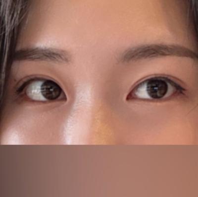 눈밑 꺼짐 처짐 시술 1개월차, 연휴에 받고 만족해요 사진 2 — 아바성형외과 눈밑지방재배치 후기