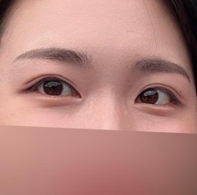 눈밑 꺼짐 처짐 시술 1개월차, 연휴에 받고 만족해요 사진 3 — 아바성형외과 눈밑지방재배치 후기