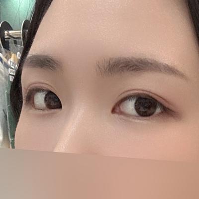 눈밑 꺼짐 처짐 시술 1개월차, 연휴에 받고 만족해요 사진 4 — 아바성형외과 눈밑지방재배치 후기