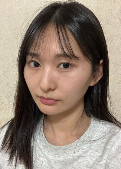눈밑지방재배치 후 눈밑 볼 다 평평해지고 화장도 진짜 편해요 사진 3 — 아바성형외과 눈밑지방재배치 후기