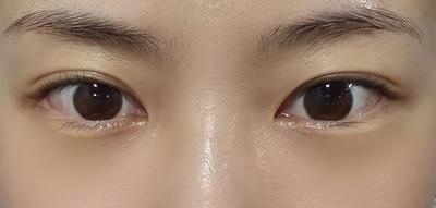 눈밑 꺼짐 수술 5일차, 붓기 빠지니 몇 년 고민 무색해요 — 아바성형외과 환자 후기 사진