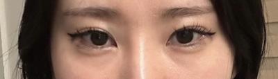 눈밑 수술 9주차, 피곤해보인다는 말 이제 안 들어요 사진 2 — 아바성형외과 눈밑지방재배치 후기