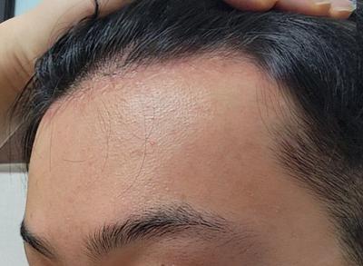 넓은 이마 개선하고 젊어보인다는 말 들어요 — 아바성형외과 환자 후기 사진