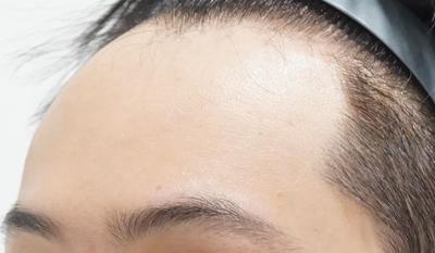 넓은 이마 개선하고 젊어보인다는 말 들어요 사진 2 — 아바성형외과 이마거상 후기