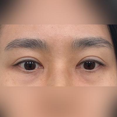 중안면거상＋눈밑지방재배치 한 달차, 인상 밝아졌다는 말 많이 들어요 사진 2 — 아바성형외과 눈밑지방재배치 후기