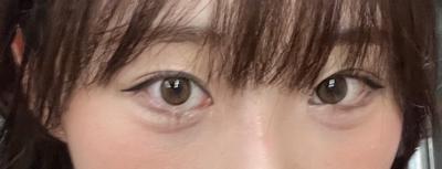 눈밑지방재배치 7주차, 애교살까지 차올라서 너무 만족해요 — 아바성형외과 환자 후기 사진