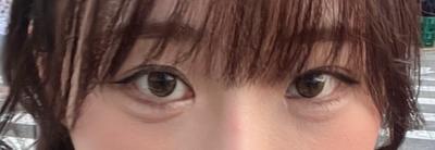 눈밑지방재배치 7주차, 애교살까지 차올라서 너무 만족해요 사진 3 — 아바성형외과 눈밑지방재배치 후기