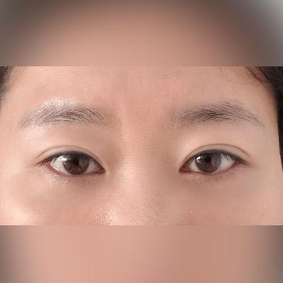 눈성형 환자 후기 — 브라운성형외과 김승수원장님께... (63)