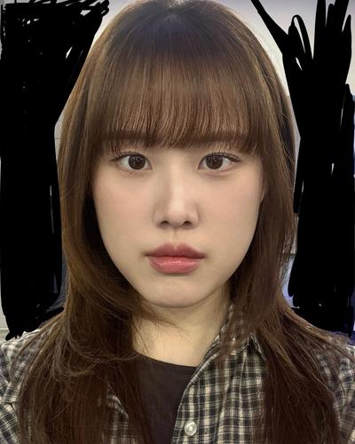 눈밑지방재배치 8주차, 눈밑 고랑 없어져 사진이 만족스러워요 — 아바성형외과 환자 후기 사진