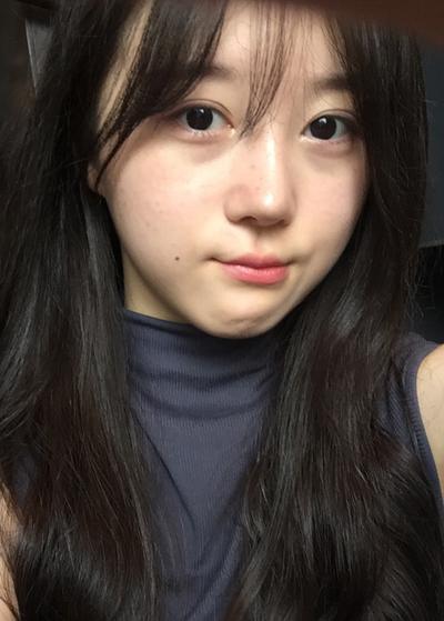 눈밑지방재배치 8주차, 피부 깨끗해졌다는 말 들어요 사진 3 — 아바성형외과 눈밑지방재배치 후기