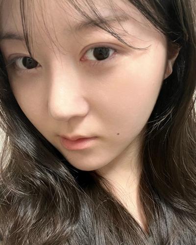 눈밑지방재배치 8주차, 피부 깨끗해졌다는 말 들어요 사진 4 — 아바성형외과 눈밑지방재배치 후기