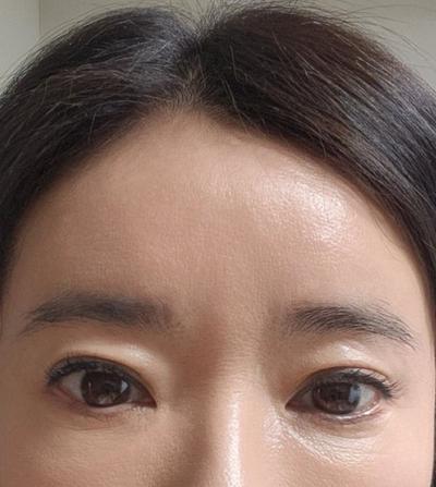 안면거상 환자 후기 — 신논현 브라운성형외과에서 김... (66)