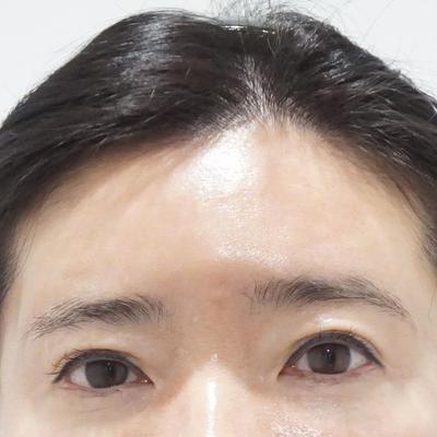 이마거상술 8주차, 예뻐졌다 젊어졌단 소리 듣고 있어요 사진 2 — 아바성형외과 안면거상 후기