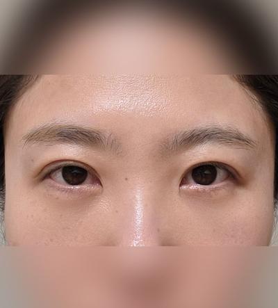 눈 수술 4주차, 피멍도 통증도 거의 없이 티 안 나요 — 아바성형외과 환자 후기 사진