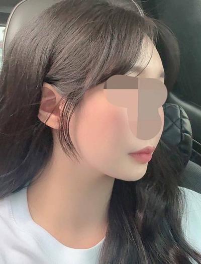 윤곽 재수술＋거상 7주차, 이젠 얼굴형 자랑하기 바빠요 — 아바성형외과 환자 후기 사진
