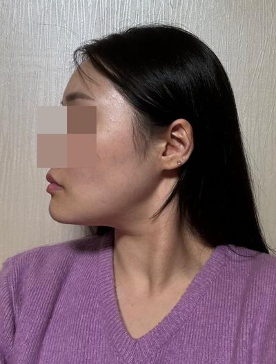 윤곽 재수술＋거상 7주차, 이젠 얼굴형 자랑하기 바빠요 사진 2 — 아바성형외과 안면거상 후기