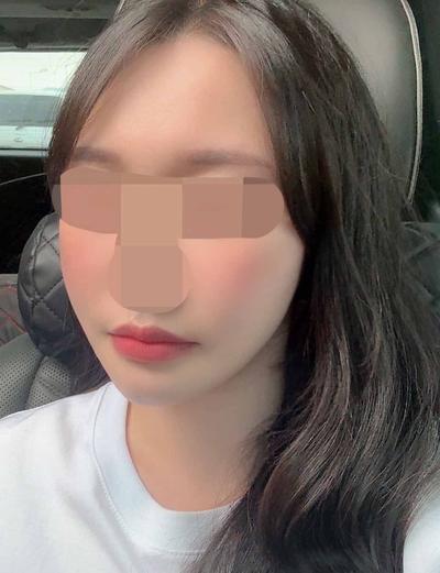 윤곽 재수술＋거상 7주차, 이젠 얼굴형 자랑하기 바빠요 사진 5 — 아바성형외과 안면거상 후기