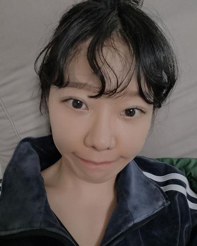 눈밑 수술 10주차, 전후사진 차이에 인상이 맑아졌어요 사진 3 — 아바성형외과 눈밑지방재배치 후기