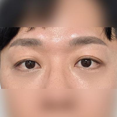 눈밑꺼짐 걱정 엄청 많았는데 시술하고 너무 만족해요 사진 1 — 아바성형외과 눈밑지방재배치 후기