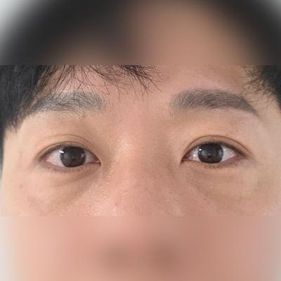 눈밑꺼짐 걱정 엄청 많았는데 시술하고 너무 만족해요 사진 2 — 아바성형외과 눈밑지방재배치 후기