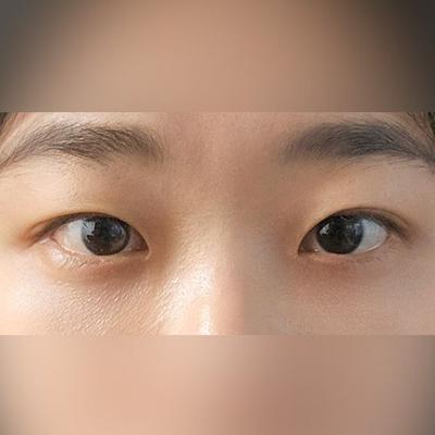 눈밑지방재배치만 했는데 효과 제대로 보고 있어요 — 아바성형외과 환자 후기 사진