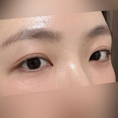 눈밑지방재배치 2주차, 붓기 빠지고 피부화장 가능해졌어요 — 아바성형외과 환자 후기 사진