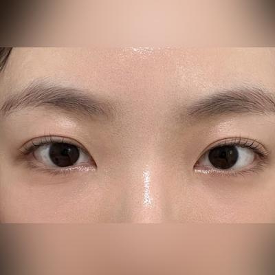 눈밑지방재배치 2주차, 붓기 빠지고 피부화장 가능해졌어요 사진 4 — 아바성형외과 눈밑지방재배치 후기