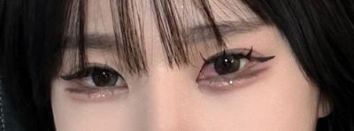 눈밑지방재배치 7주차, 다크서클 진짜 다 없어졌어요 — 아바성형외과 환자 후기 사진