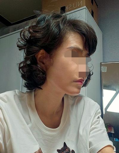 안면거상＋윤곽 12주차, 50대 중반인데 턱라인 잡히고 젊어졌어요 — 아바성형외과 환자 후기 사진