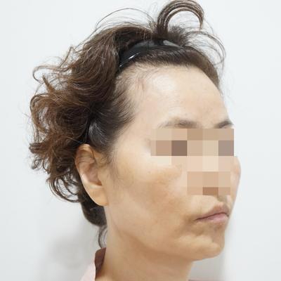 안면거상＋윤곽 12주차, 50대 중반인데 턱라인 잡히고 젊어졌어요 사진 2 — 아바성형외과 안면거상 후기