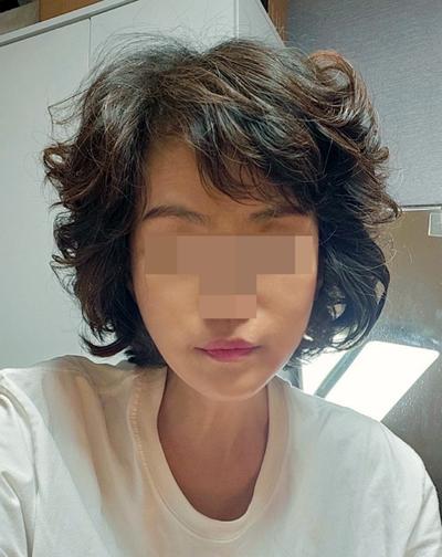 안면거상＋윤곽 12주차, 50대 중반인데 턱라인 잡히고 젊어졌어요 사진 4 — 아바성형외과 안면거상 후기