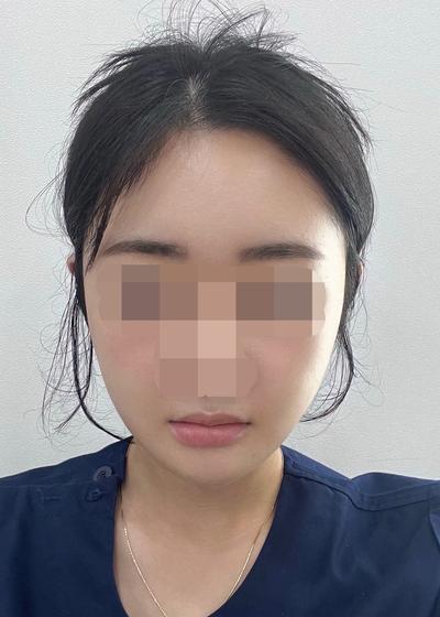 이중턱지방흡입 5주차, 안 빠지던 턱살 단번에 없어졌어요 — 아바성형외과 환자 후기 사진