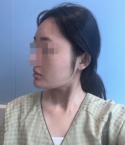 이중턱지방흡입 5주차, 안 빠지던 턱살 단번에 없어졌어요 사진 3 — 아바성형외과 이중턱·윤곽 후기