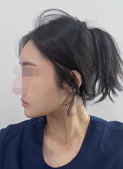 이중턱지방흡입 5주차, 안 빠지던 턱살 단번에 없어졌어요 사진 4 — 아바성형외과 이중턱·윤곽 후기