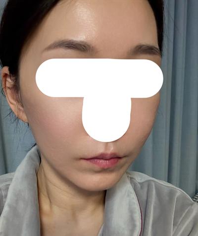 안면거상 9주차, 얼굴이 탱탱해져서 진짜 만족해요 — 아바성형외과 환자 후기 사진