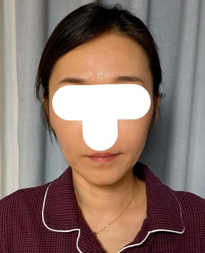 안면거상 9주차, 얼굴이 탱탱해져서 진짜 만족해요 사진 2 — 아바성형외과 안면거상 후기