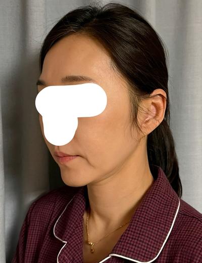 안면거상 9주차, 얼굴이 탱탱해져서 진짜 만족해요 사진 3 — 아바성형외과 안면거상 후기