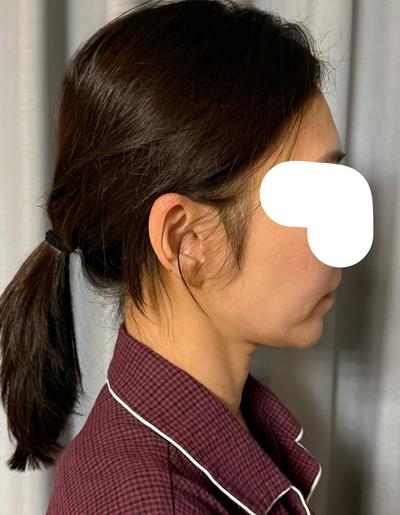 안면거상 9주차, 얼굴이 탱탱해져서 진짜 만족해요 사진 4 — 아바성형외과 안면거상 후기