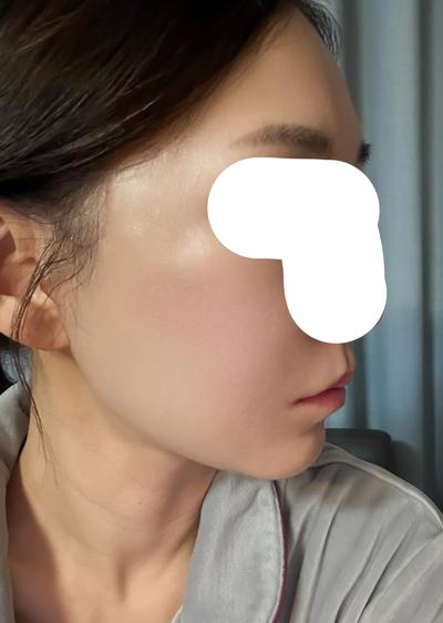 안면거상 9주차, 얼굴이 탱탱해져서 진짜 만족해요 사진 5 — 아바성형외과 안면거상 후기