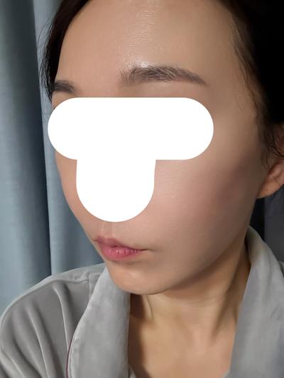 안면거상 9주차, 얼굴이 탱탱해져서 진짜 만족해요 사진 6 — 아바성형외과 안면거상 후기