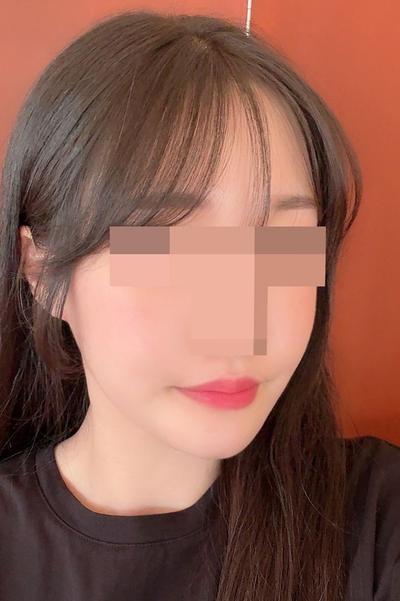 윤곽 3종 재수술＋안면거상 5주차, 포토샵 졸업했어요 — 아바성형외과 환자 후기 사진