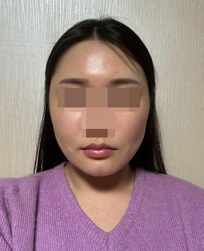 윤곽 3종 재수술＋안면거상 5주차, 포토샵 졸업했어요 사진 3 — 아바성형외과 안면거상 후기