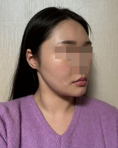 윤곽 3종 재수술＋안면거상 5주차, 포토샵 졸업했어요 사진 4 — 아바성형외과 안면거상 후기