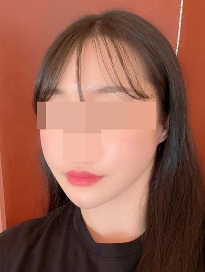 윤곽 3종 재수술＋안면거상 5주차, 포토샵 졸업했어요 사진 5 — 아바성형외과 안면거상 후기