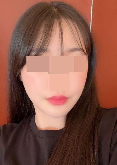 윤곽 3종 재수술＋안면거상 5주차, 포토샵 졸업했어요 사진 6 — 아바성형외과 안면거상 후기