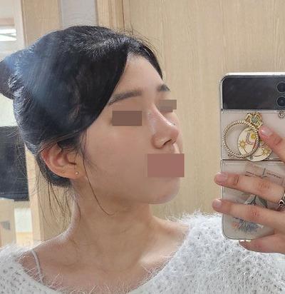 코성형 5주차, 낮고 뭉툭했던 코가 내 코처럼 자연스러워요 — 아바성형외과 환자 후기 사진
