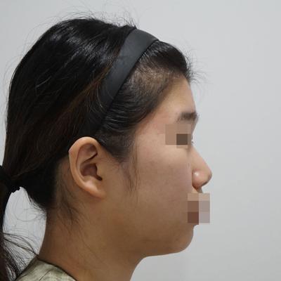 코성형 5주차, 낮고 뭉툭했던 코가 내 코처럼 자연스러워요 사진 2 — 아바성형외과 코성형 후기