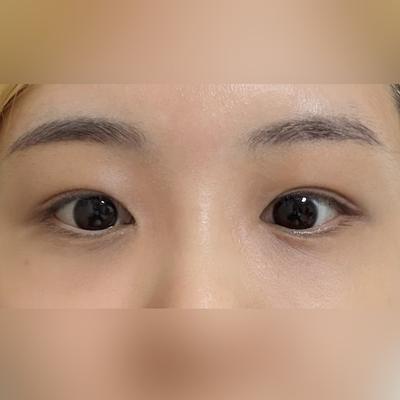 눈수술 후기, 피곤하다는 말 이제 안 들어요 — 아바성형외과 환자 후기 사진