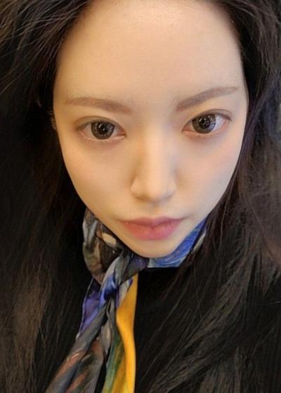 눈밑지방재배치 2주차, 오래 고민했는데 진작 할 걸 그랬어요 사진 3 — 아바성형외과 눈밑지방재배치 후기